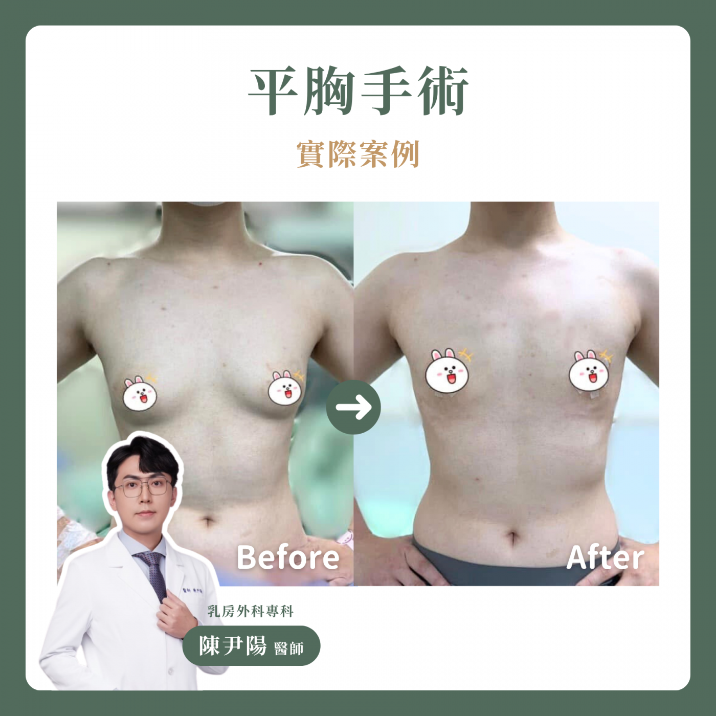 平胸手術案例分享